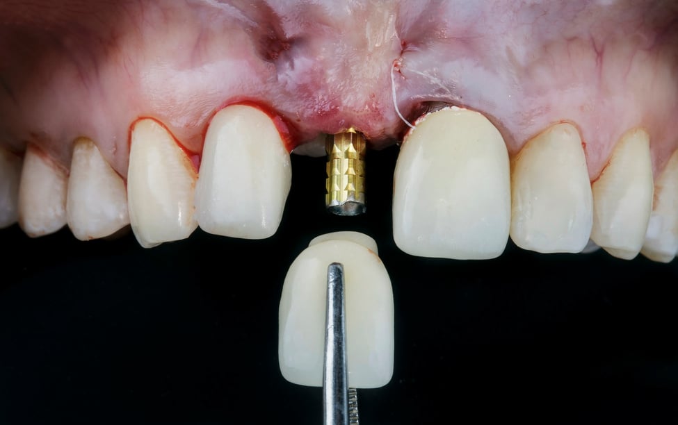 installation paste temporary dental crown of the central tooth o