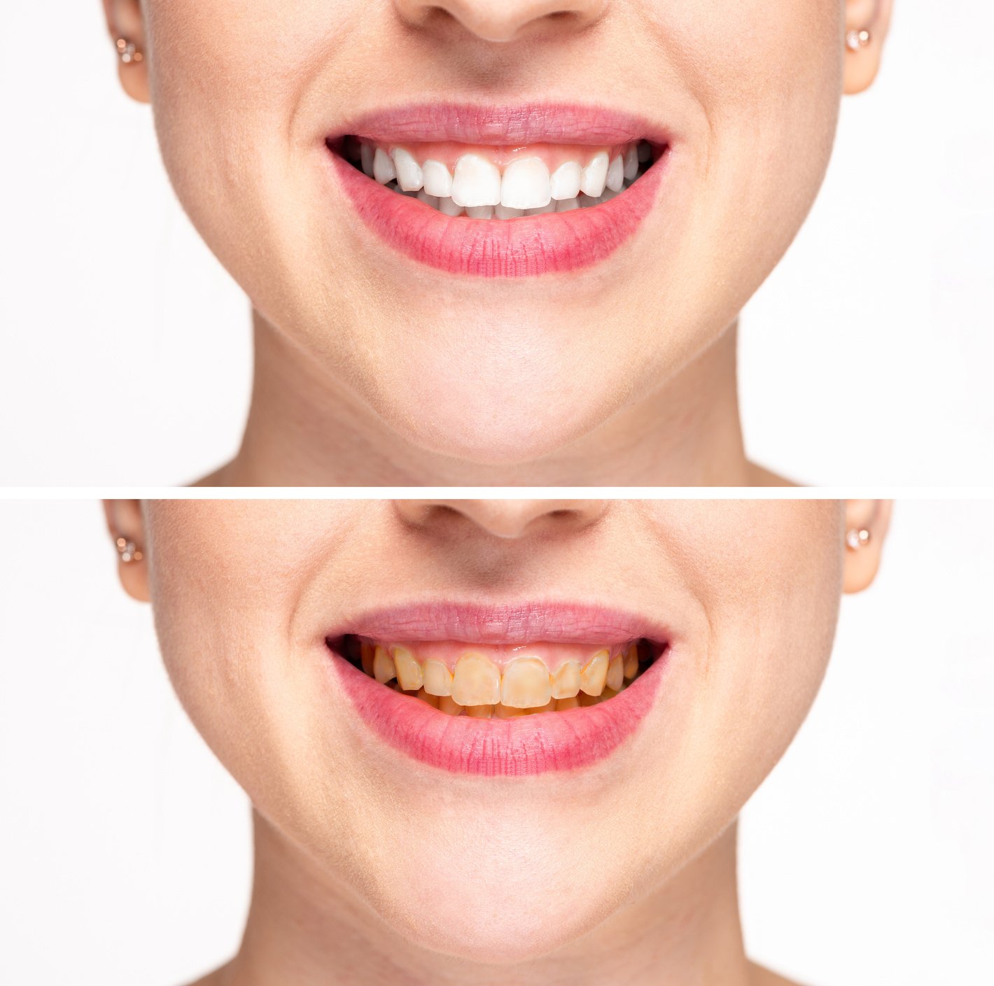 Teeth Before and After Whitening